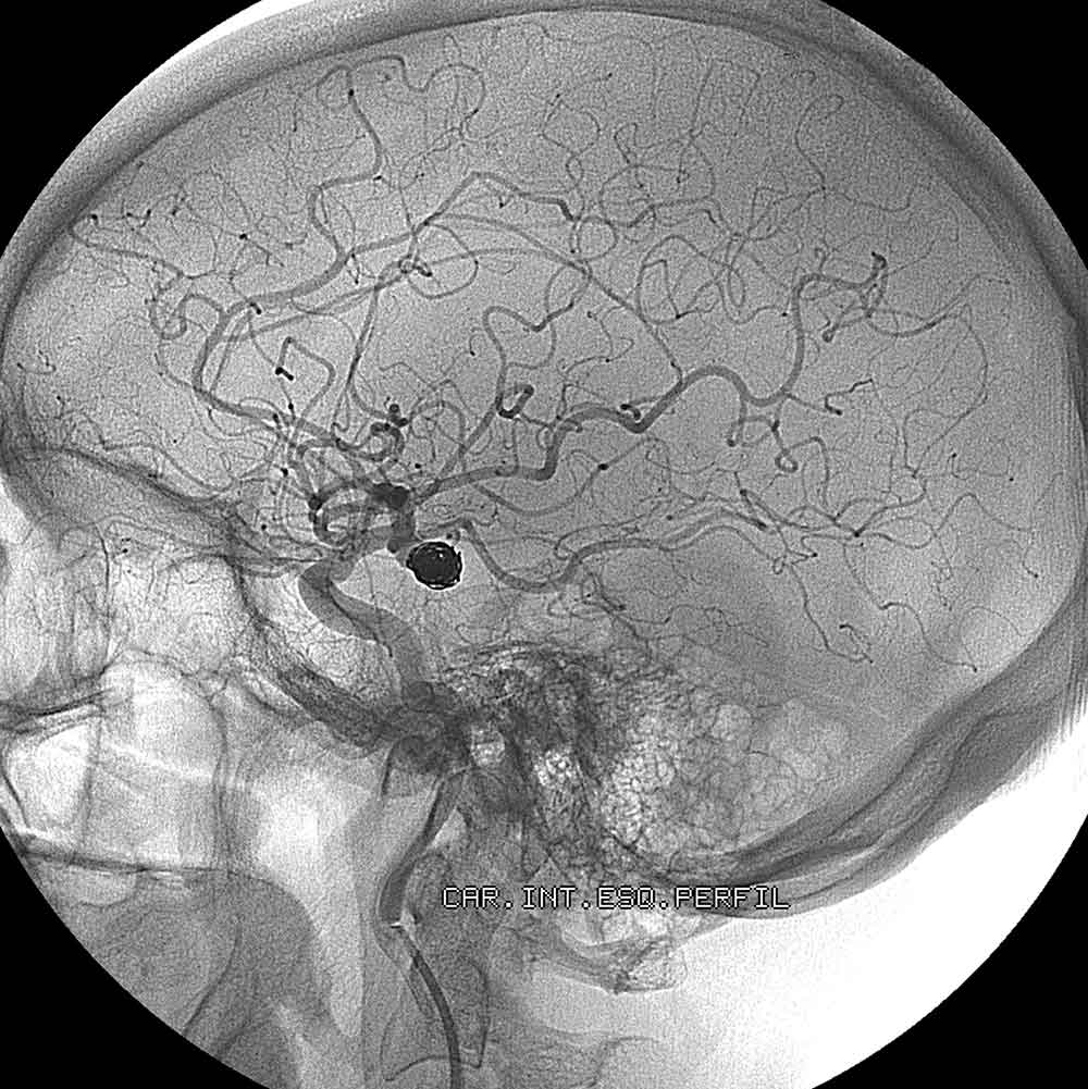 A cerebral angiogram X-Ray image of the vascular system of the brain with contrast