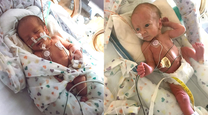 Preemie Twin Babies Receive Life-Saving Care 